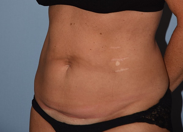 Tummy Tuck Before & After Gallery - Patient 178926811 - Image 3