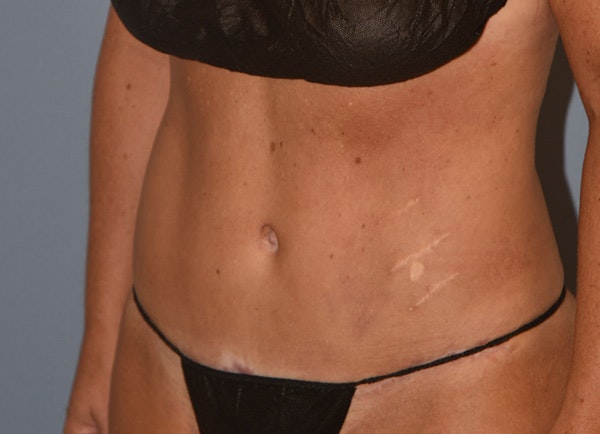 Tummy Tuck Before & After Gallery - Patient 178926811 - Image 4