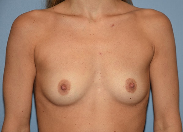 Breast Augmentation Before & After Gallery - Patient 178927234 - Image 1