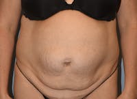 Tummy Tuck Before & After Gallery - Patient 178928534 - Image 1