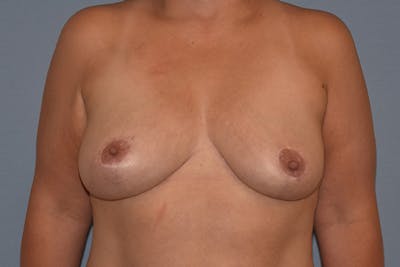 Breast Reduction Before & After Gallery - Patient 178929616 - Image 2
