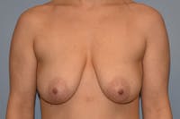 Breast Reduction Before & After Gallery - Patient 178930072 - Image 1