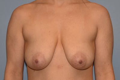 Breast Reduction Before & After Gallery - Patient 178930072 - Image 1