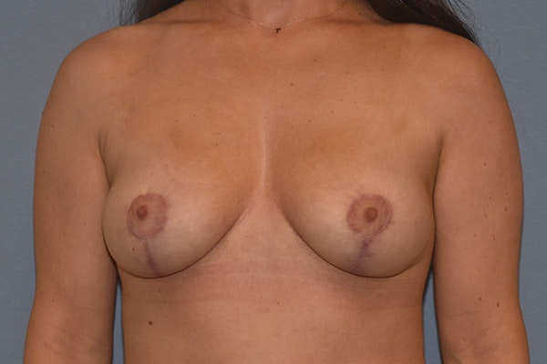 Breast Reduction Before & After Gallery - Patient 178930072 - Image 2
