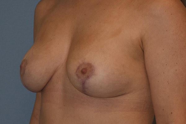 Breast Reduction Before & After Gallery - Patient 178930072 - Image 4