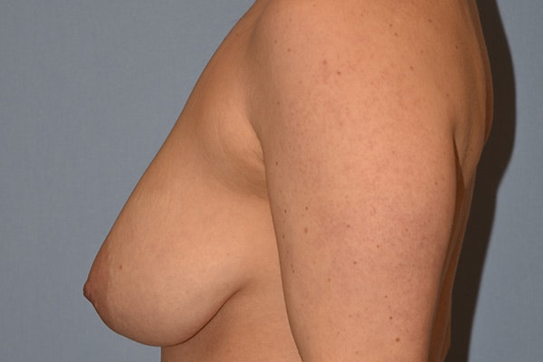 Breast Reduction Before & After Gallery - Patient 178930072 - Image 5