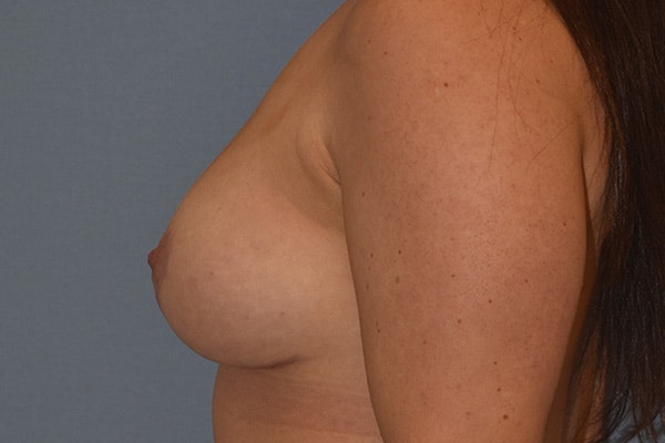Breast Reduction Before & After Gallery - Patient 178930072 - Image 6