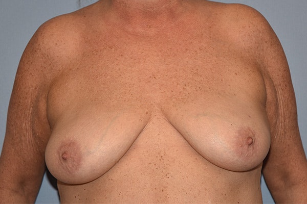 Breast Reconstruction Before & After Gallery - Patient 178930629 - Image 1