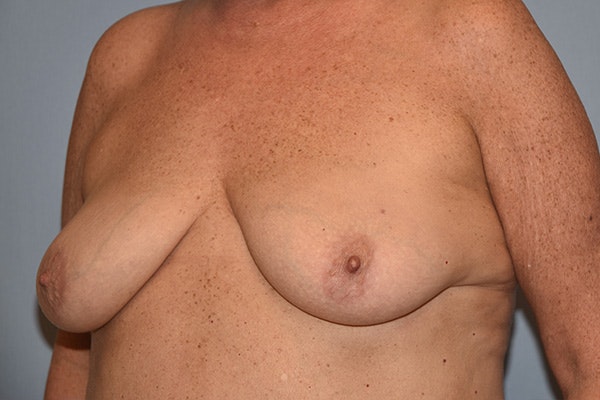 Breast Reconstruction Before & After Gallery - Patient 178930629 - Image 3