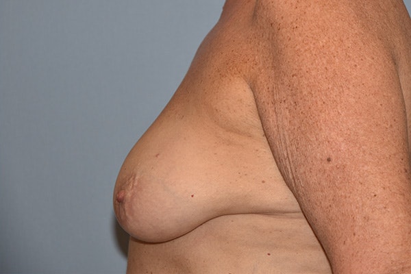 Breast Reconstruction Before & After Gallery - Patient 178930629 - Image 5