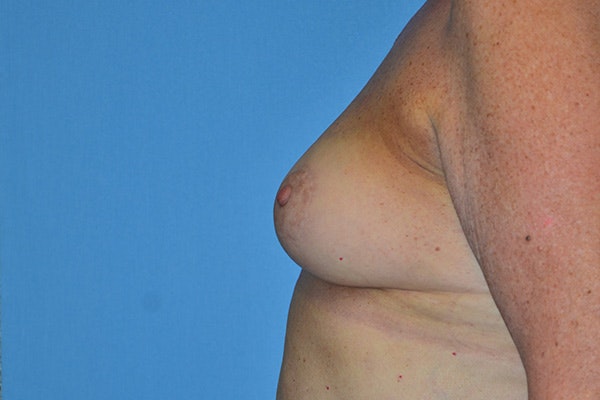 Breast Reconstruction Before & After Gallery - Patient 178930629 - Image 6