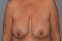 Breast Reduction Before & After Gallery - Patient 178931107 - Image 1