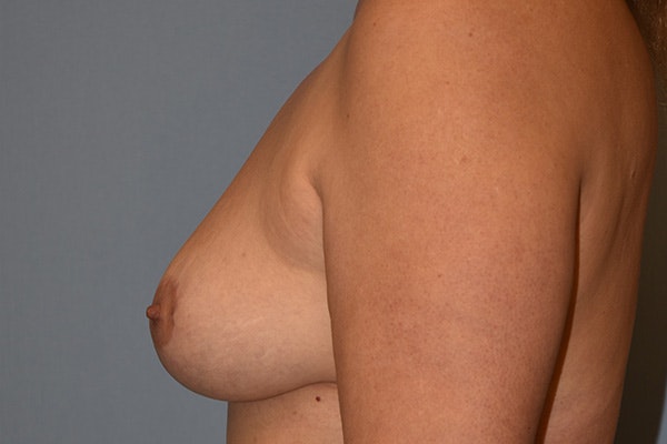 Breast Reduction Before & After Gallery - Patient 178931107 - Image 6