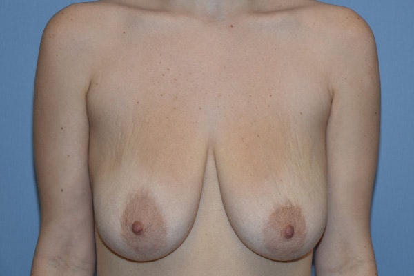 Breast Lift Before & After Gallery - Patient 178931645 - Image 1