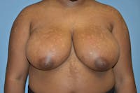 Breast Reduction Before & After Gallery - Patient 178931691 - Image 1