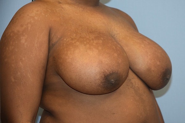 Breast Reduction Before & After Gallery - Patient 178931691 - Image 3