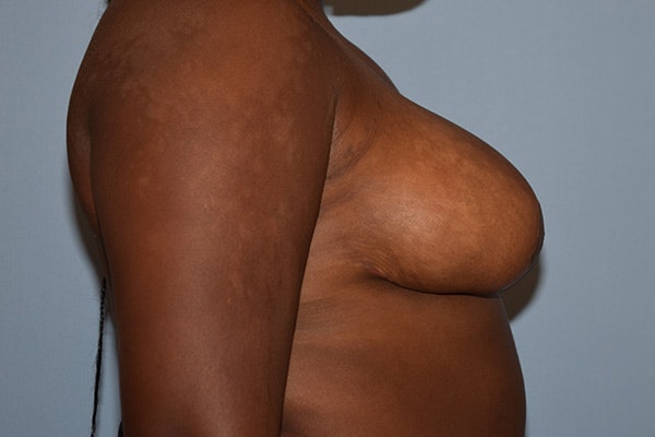Breast Reduction Before & After Gallery - Patient 178931691 - Image 6