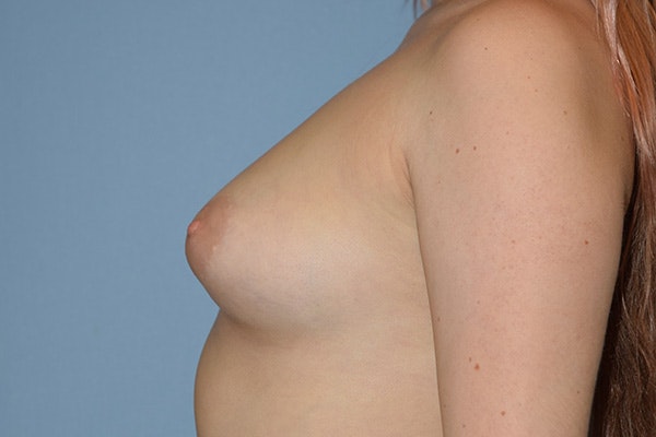 Breast Augmentation Before & After Gallery - Patient 178932172 - Image 5