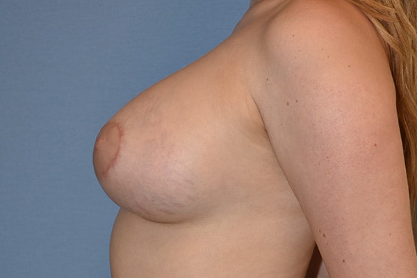 Breast Augmentation Before & After Gallery - Patient 178932172 - Image 6