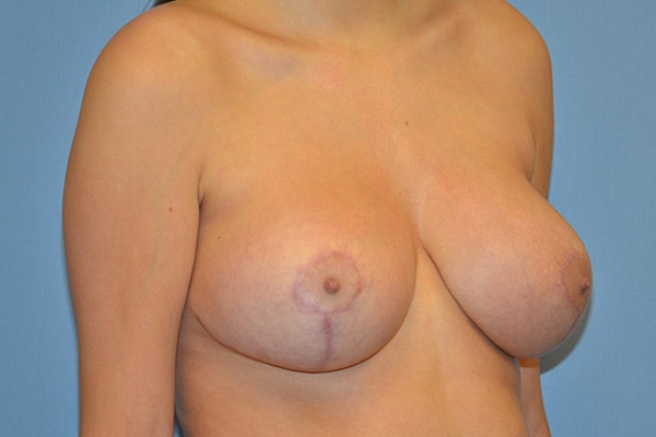 Breast Reduction Before & After Gallery - Patient 178932661 - Image 4