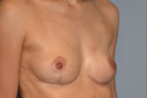 Breast Reduction Before & After Gallery - Patient 178932790 - Image 4