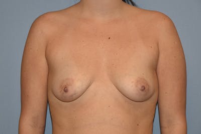 Breast Augmentation Before & After Gallery - Patient 184640269 - Image 1