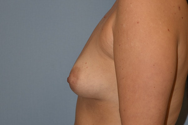 Breast Augmentation Before & After Gallery - Patient 184640269 - Image 5