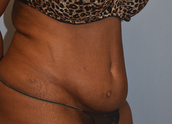 Tummy Tuck Before & After Gallery - Patient 184640478 - Image 3
