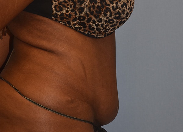 Tummy Tuck Before & After Gallery - Patient 184640478 - Image 5