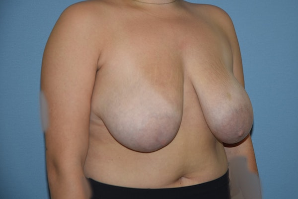 Breast Reduction Before & After Gallery - Patient 184640615 - Image 3
