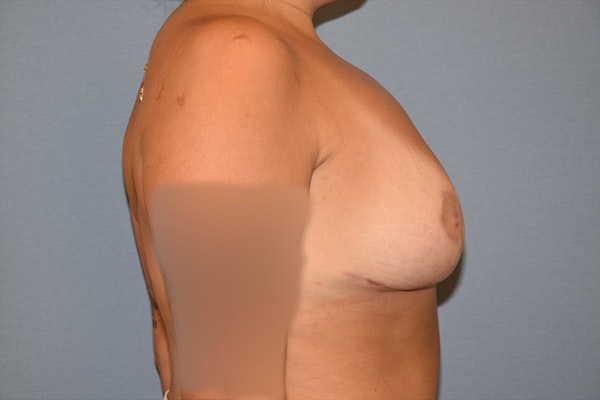 Breast Reduction Before & After Gallery - Patient 184640615 - Image 6