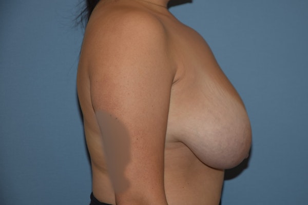 Breast Reduction Before & After Gallery - Patient 184640615 - Image 5