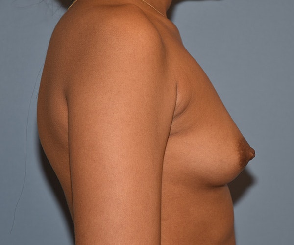 Breast Augmentation Before & After Gallery - Patient 184640659 - Image 5