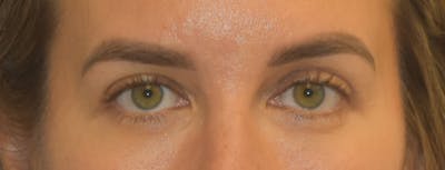 Eyelid Lift Before & After Gallery - Patient 639660 - Image 2