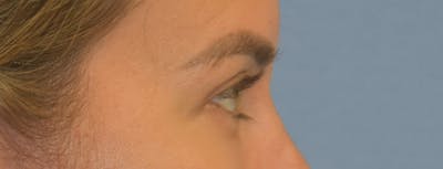 Eyelid Lift Before & After Gallery - Patient 639660 - Image 6