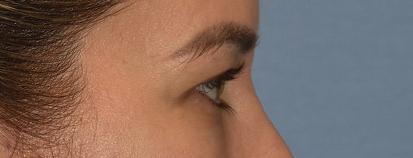 Eyelid Lift Before & After Gallery - Patient 639660 - Image 5