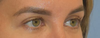 Eyelid Lift Before & After Gallery - Patient 639660 - Image 4