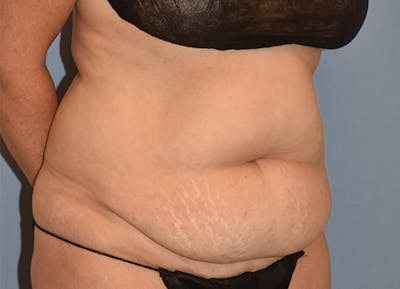 Tummy Tuck Before & After Gallery - Patient 770757 - Image 1