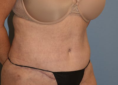 Tummy Tuck Before & After Gallery - Patient 770757 - Image 2