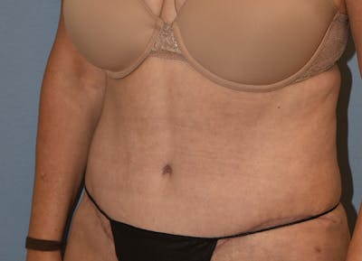 Tummy Tuck Before & After Gallery - Patient 770757 - Image 6
