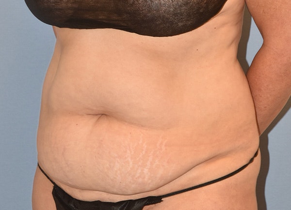 Tummy Tuck Before & After Gallery - Patient 770757 - Image 5