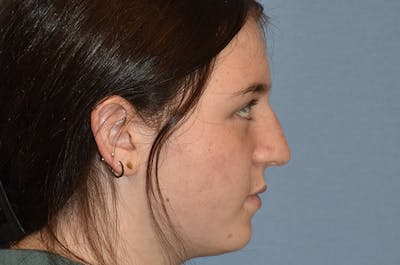 Rhinoplasty Before & After Gallery - Patient 343464 - Image 1