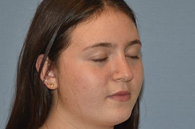 Rhinoplasty Before & After Gallery - Patient 343464 - Image 6