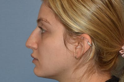 Rhinoplasty Before & After Gallery - Patient 257498 - Image 1