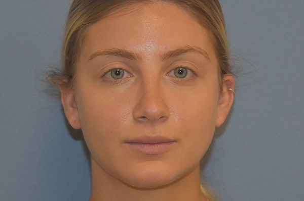 Rhinoplasty Before & After Gallery - Patient 257498 - Image 3