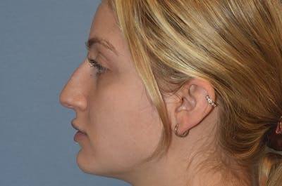 Rhinoplasty Before & After Gallery - Patient 257498 - Image 2