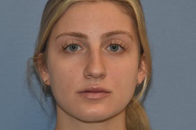 Rhinoplasty Before & After Gallery - Patient 257498 - Image 4