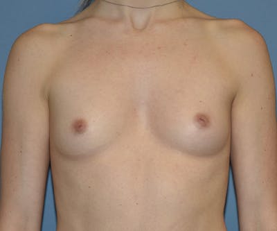 Breast Augmentation Before & After Gallery - Patient 243267 - Image 1