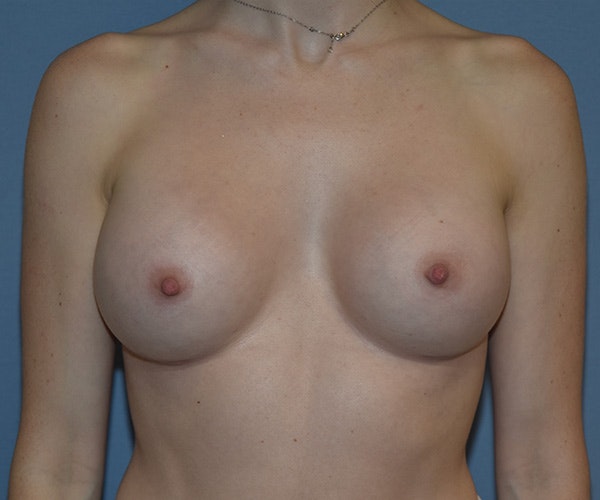 Breast Augmentation Before & After Gallery - Patient 243267 - Image 2