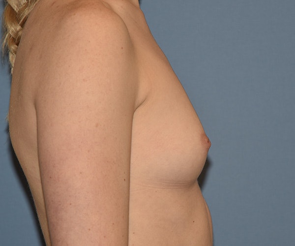 Breast Augmentation Before & After Gallery - Patient 243267 - Image 5
